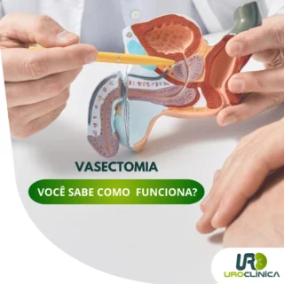 A vasectomia é um procedimento simples e seguro que impede que os espermatozoides cheguem ao sêmen, evitando a gravidez.✅ Como é feita?
- Procedimento rápido (cerca de 20–30 minutos);
- Realizado com anestesia local;
- Pequeno corte ou técnica sem bisturi;
- Alta no mesmo dia.⏳ Recuperação
- Retorno às atividades leves em poucos dias;
- Evitar esforço físico por cerca de 1 semana;
- Necessário manter outro método contraceptivo até confirmação por espermograma.❗ Mitos e Verdades
- Não causa impotência;
- Não altera a testosterona;
- Não interfere no prazer sexual;
- É considerada um método definitivo (reversão é possível, mas não garantida).A decisão deve ser consciente e feita com orientação médica.📲 Agende uma avaliação e tire todas as suas dúvidas.
☎ (43) 3472-7199
https://uroclinica.net.br/
📍 Rua Emílio Ganzert, 305, Ivaiporã - PR⠀#vasectomia #saúdodohomem #procedimento #checkupmasculino #urologia #clínicaurológica #uroclinica